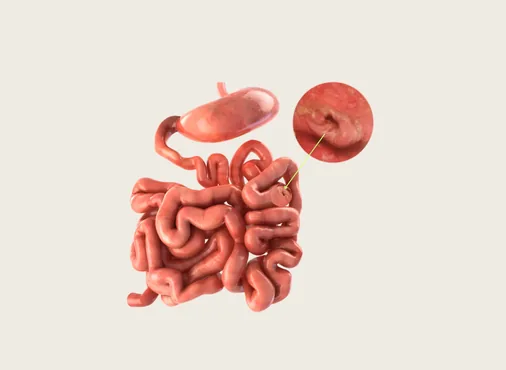 Intestinal Perforation consultation at Niraaya Hospital